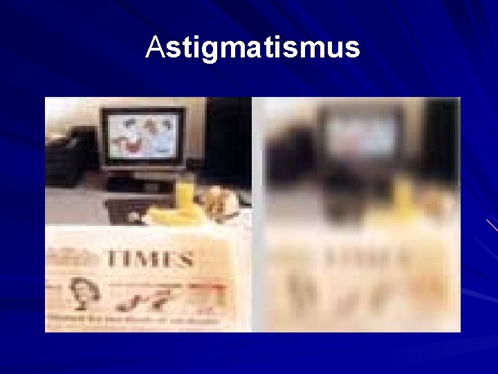 Astigmatismus Astigmatismus