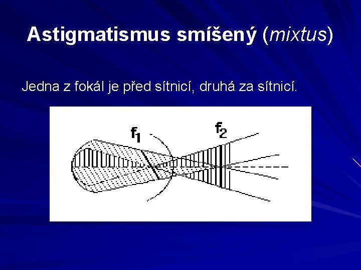 Astigmatismus smíšený (mixtus) Jedna z fokál je před sítnicí, druhá za sítnicí. Astigmatismus smíšený (mixtus) Jedna z fokál je před sítnicí, druhá za sítnicí.