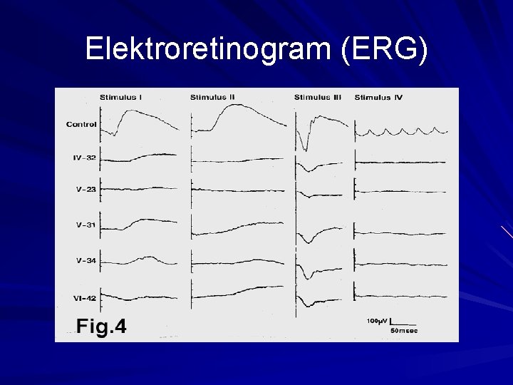 Elektroretinogram (ERG) Elektroretinogram (ERG)