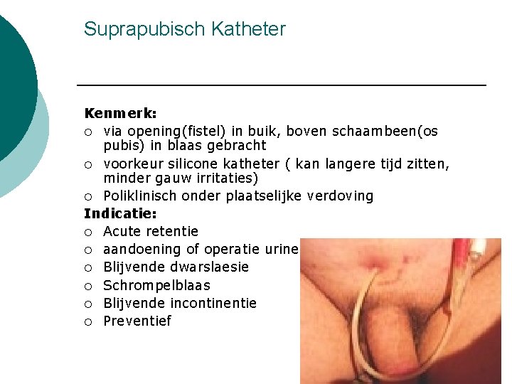 Suprapubisch Katheter Kenmerk: ¡ via opening(fistel) in buik, boven schaambeen(os pubis) in blaas gebracht
