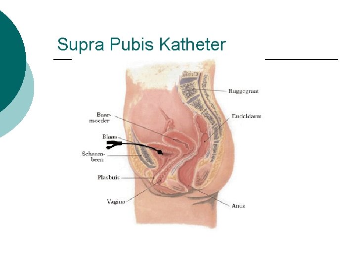 Supra Pubis Katheter 