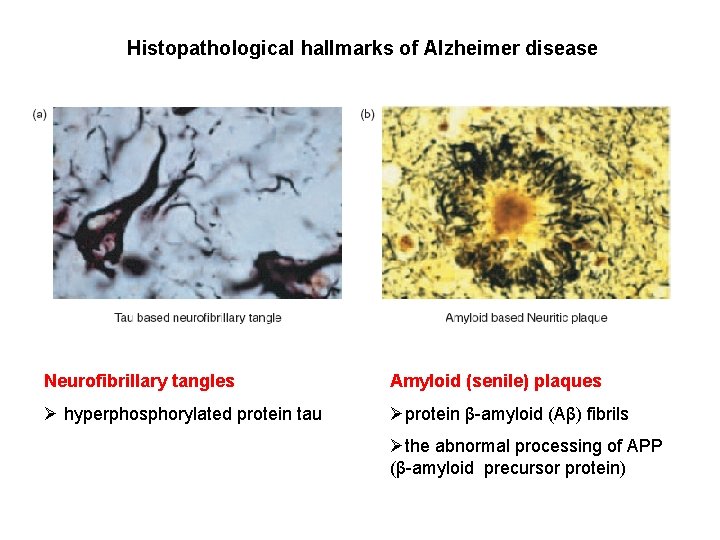 Histopathological hallmarks of Alzheimer disease Neurofibrillary tangles Amyloid (senile) plaques Ø hyperphosphorylated protein tau