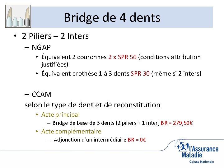 Bridge de 4 dents • 2 Piliers – 2 Inters – NGAP • Équivalent