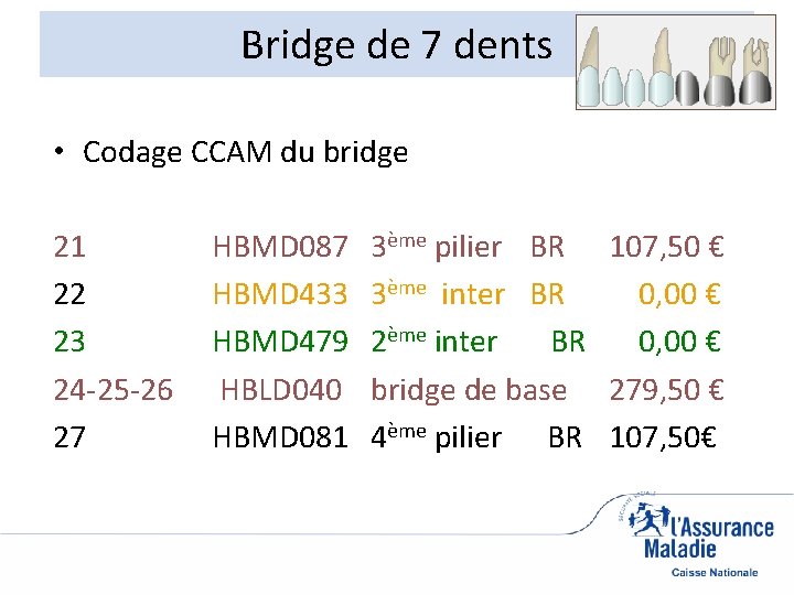 Bridge de 7 dents • Codage CCAM du bridge 21 22 23 24 -25
