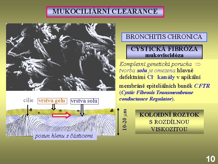 MUKOCILIÁRNÍ CLEARANCE BRONCHITIS CHRONICA CYSTICKÁ FIBRÓZA mukoviscidóza Komplexní genetická porucha tvorba solu je omezena