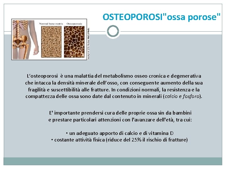 OSTEOPOROSI"ossa porose" L’osteoporosi è una malattia del metabolismo osseo cronica e degenerativa che intacca