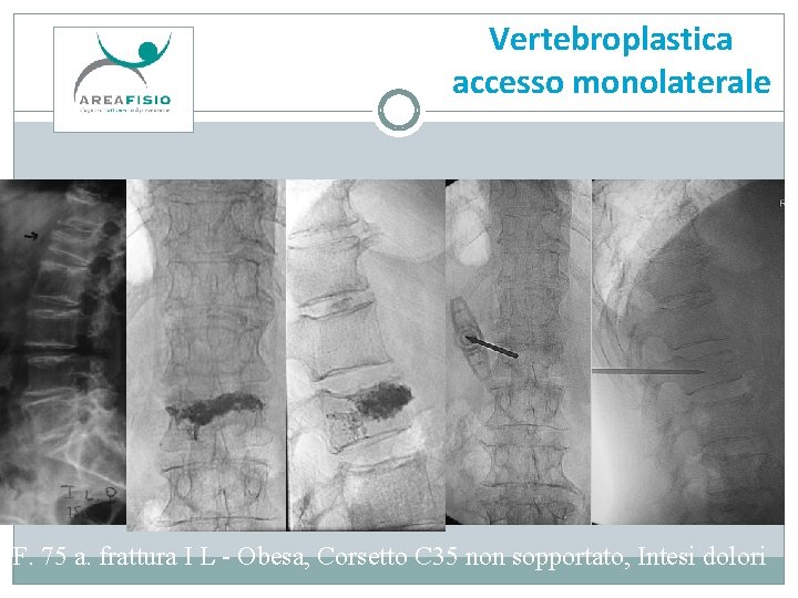 Vertebroplastica accesso monolaterale F. 75 a. frattura I L - Obesa, Corsetto C 35