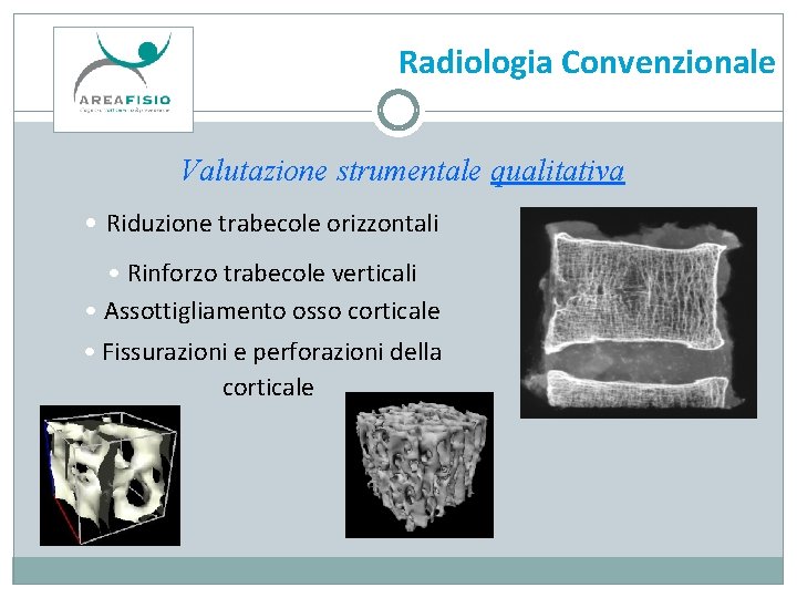 Radiologia Convenzionale Valutazione strumentale qualitativa • Riduzione trabecole orizzontali • Rinforzo trabecole verticali •