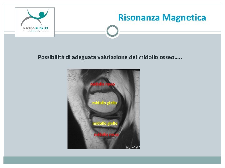 Risonanza Magnetica Possibilità di adeguata valutazione del midollo osseo…. . midollo rosso midollo giallo