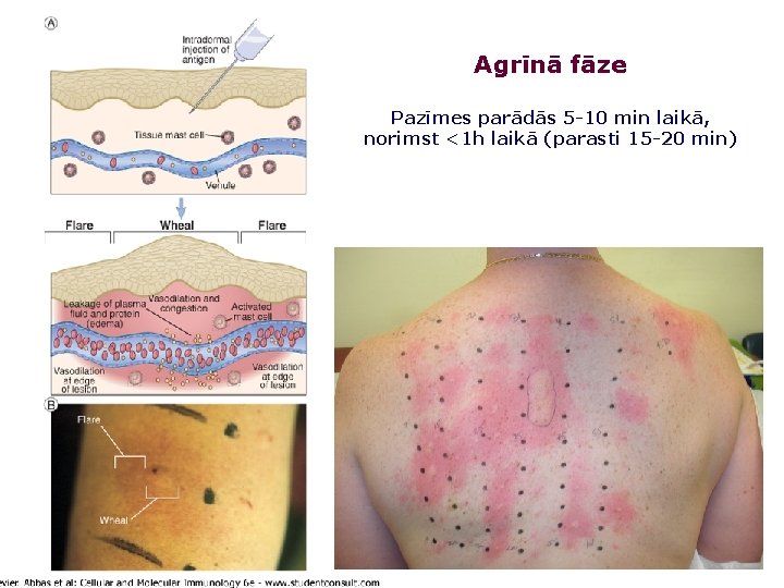 Agrīnā fāze Pazīmes parādās 5 -10 min laikā, norimst <1 h laikā (parasti 15