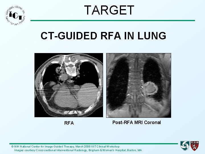 TARGET CT-GUIDED RFA IN LUNG RFA Post-RFA MRI Coronal © NIH National Center for
