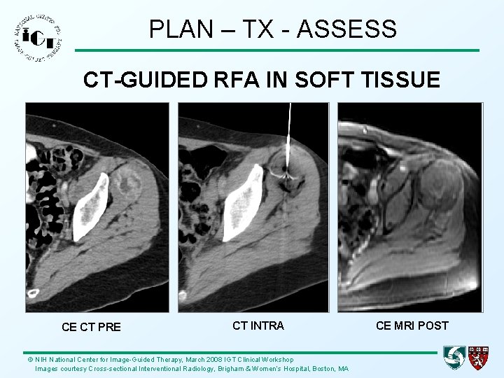 PLAN – TX - ASSESS CT-GUIDED RFA IN SOFT TISSUE CE CT PRE CT