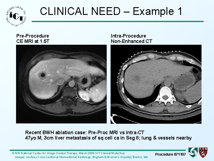 CLINICAL NEED – Example 1 Pre-Procedure CE MRI at 1. 5 T Intra-Procedure Non-Enhanced
