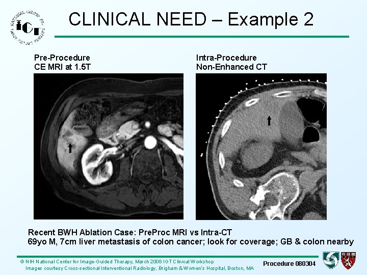 CLINICAL NEED – Example 2 Pre-Procedure CE MRI at 1. 5 T Intra-Procedure Non-Enhanced