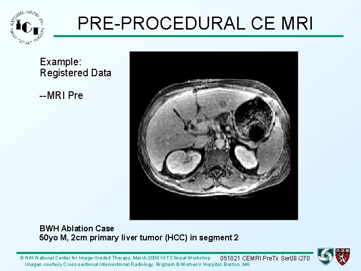 PRE-PROCEDURAL CE MRI Example: Registered Data --MRI Pre BWH Ablation Case 50 yo M,