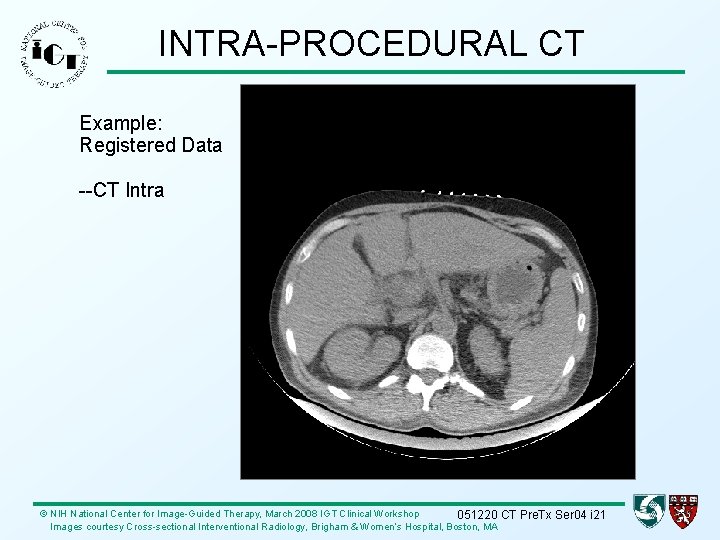 INTRA-PROCEDURAL CT Example: Registered Data --CT Intra © NIH National Center for Image-Guided Therapy,