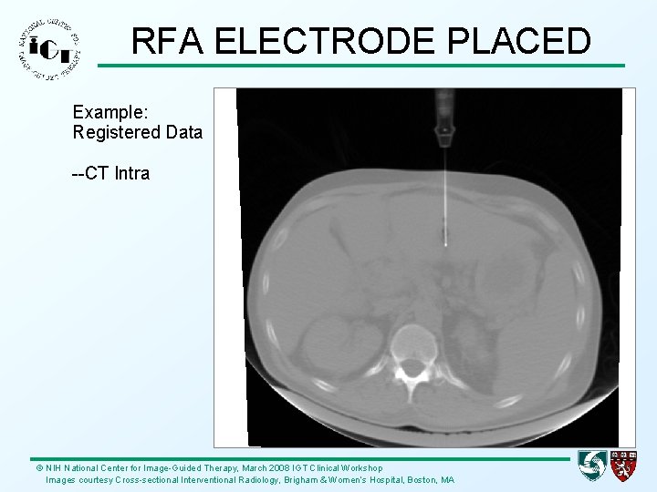 RFA ELECTRODE PLACED Example: Registered Data --CT Intra © NIH National Center for Image-Guided