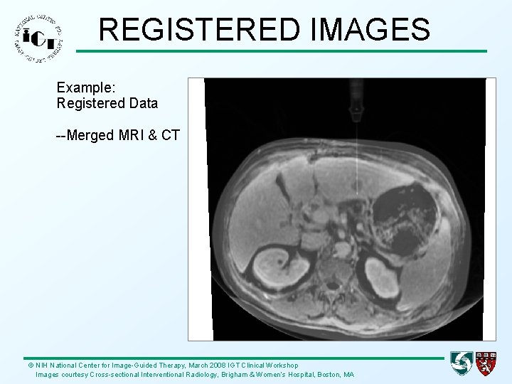 REGISTERED IMAGES Example: Registered Data --Merged MRI & CT © NIH National Center for