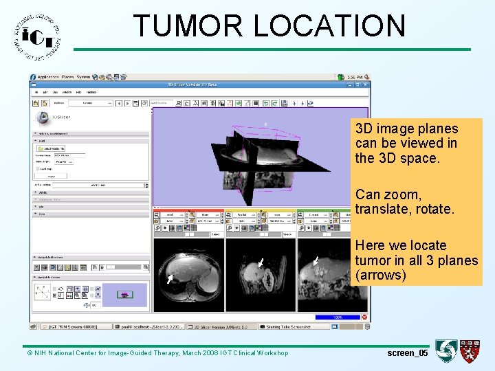 TUMOR LOCATION 3 D image planes can be viewed in the 3 D space.