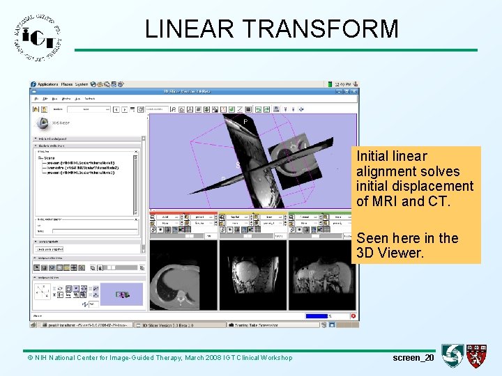 LINEAR TRANSFORM Initial linear alignment solves initial displacement of MRI and CT. Seen here