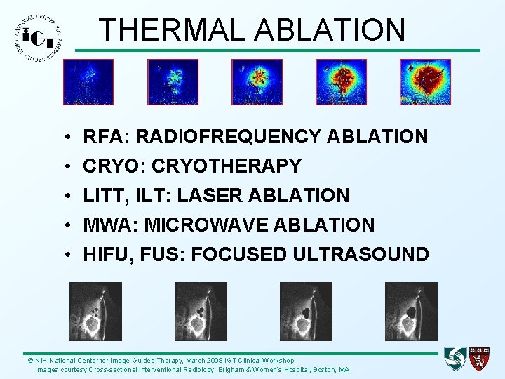 THERMAL ABLATION • • • RFA: RADIOFREQUENCY ABLATION CRYO: CRYOTHERAPY LITT, ILT: LASER ABLATION