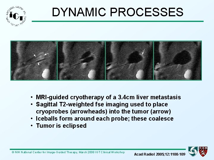 DYNAMIC PROCESSES • MRI-guided cryotherapy of a 3. 4 cm liver metastasis • Sagittal