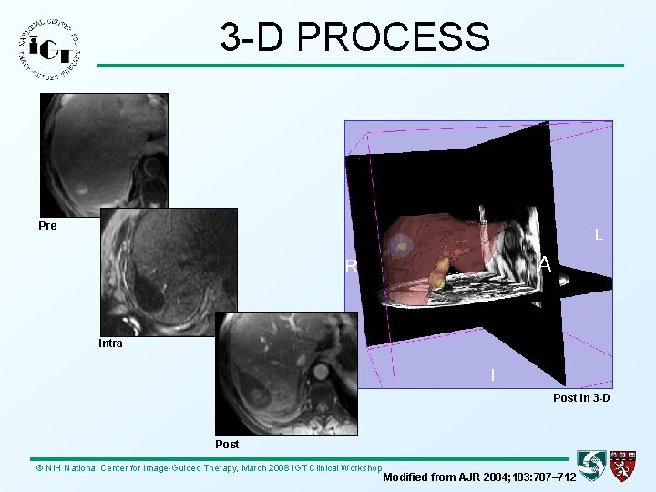 3 -D PROCESS Pre Intra Post in 3 -D Post © NIH National Center