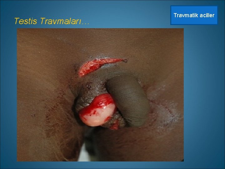 Testis Travmaları… Travmatik aciller 