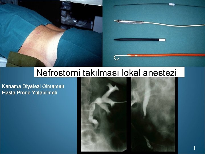 Nefrostomi takılması lokal anestezi Kanama Diyatezi Olmamalı Hasta Prone Yatabilmeli 1 