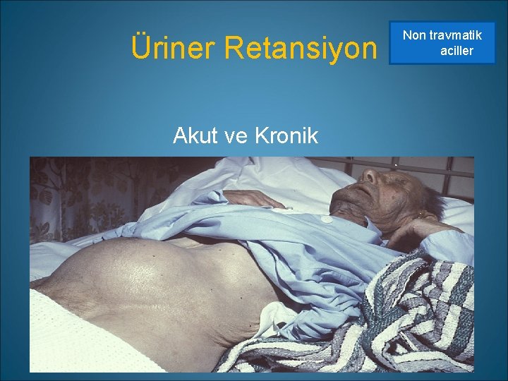 Üriner Retansiyon Akut ve Kronik Non travmatik aciller 