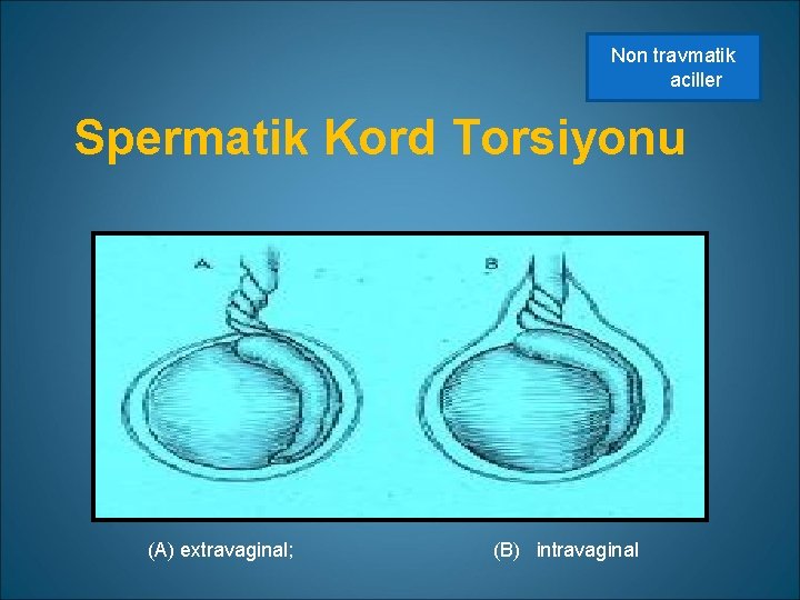 Non travmatik aciller Spermatik Kord Torsiyonu (A) extravaginal; (B) intravaginal 