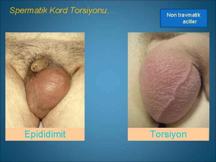 Spermatik Kord Torsiyonu… Epididimit Non travmatik aciller Torsiyon 