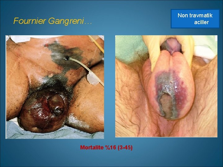 Fournier Gangreni… Mortalite %16 (3 -45) Non travmatik aciller 