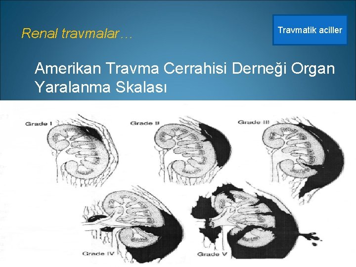 Renal travmalar… Travmatik aciller Amerikan Travma Cerrahisi Derneği Organ Yaralanma Skalası 