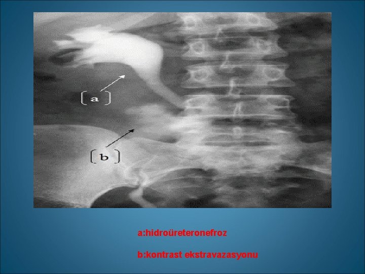 a: hidroüreteronefroz b: kontrast ekstravazasyonu 