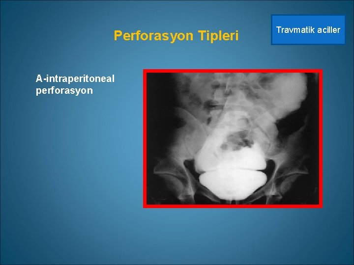 Perforasyon Tipleri A-intraperitoneal perforasyon Travmatik aciller 