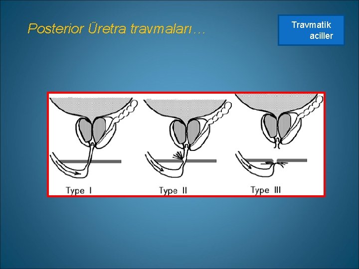 Posterior Üretra travmaları… Travmatik aciller 