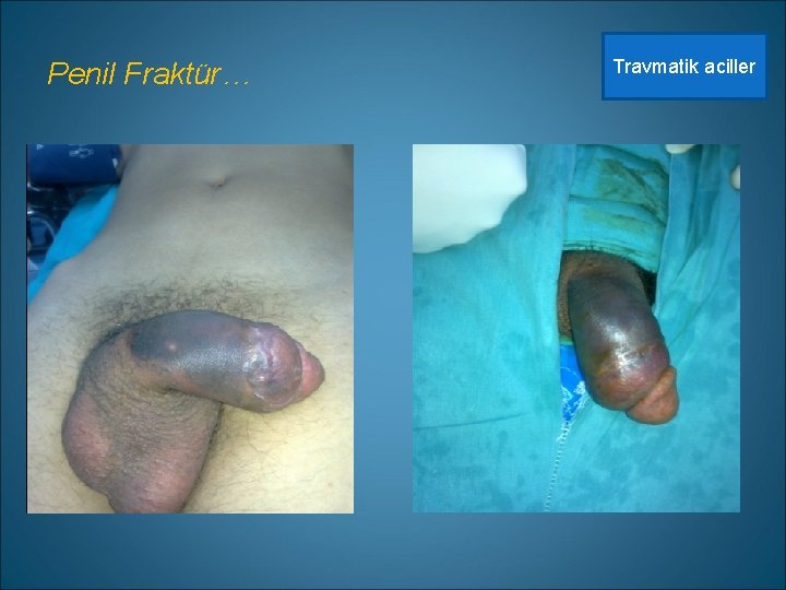 Penil Fraktür… Travmatik aciller 