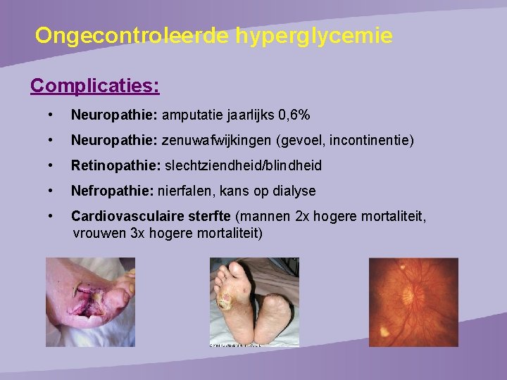 Ongecontroleerde hyperglycemie Complicaties: • Neuropathie: amputatie jaarlijks 0, 6% • Neuropathie: zenuwafwijkingen (gevoel, incontinentie)