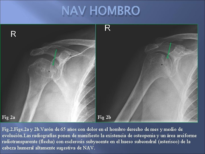 NAV HOMBRO * * Fig 2 a Fig 2 b Fig. 2. Figs. 2