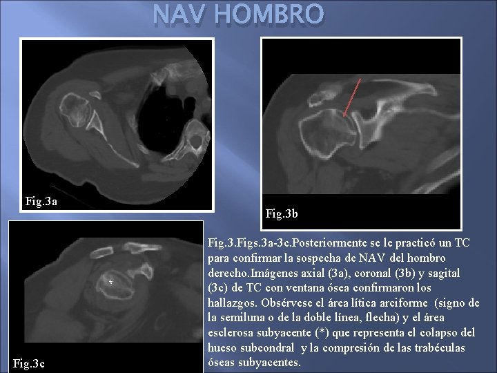 NAV HOMBRO Fig. 3 a Fig. 3 b * Fig. 3 c Fig. 3.