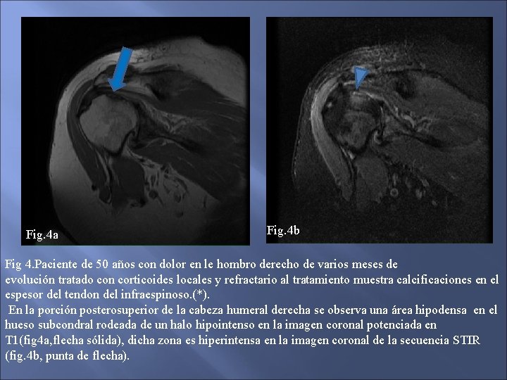 Fig. 4 a Fig. 4 b Fig 4. Paciente de 50 años con dolor