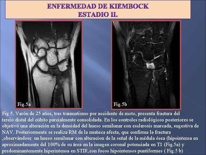 Fig. 5 a Fig. 5 b Fig 5. Varón de 25 años, tras traumatismo