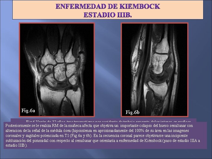 Fig. 6 a Fig. 6 b Fig 6. Varón de 32 años, tras traumatismo