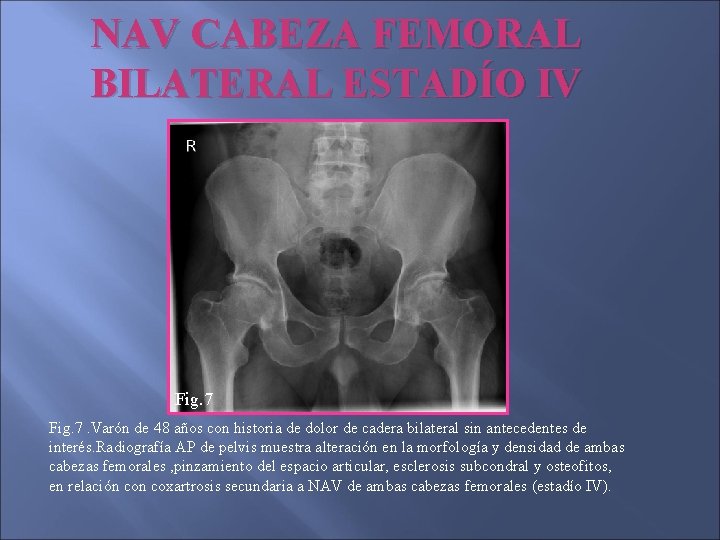 NAV CABEZA FEMORAL BILATERAL ESTADÍO IV Fig. 7. Varón de 48 años con historia