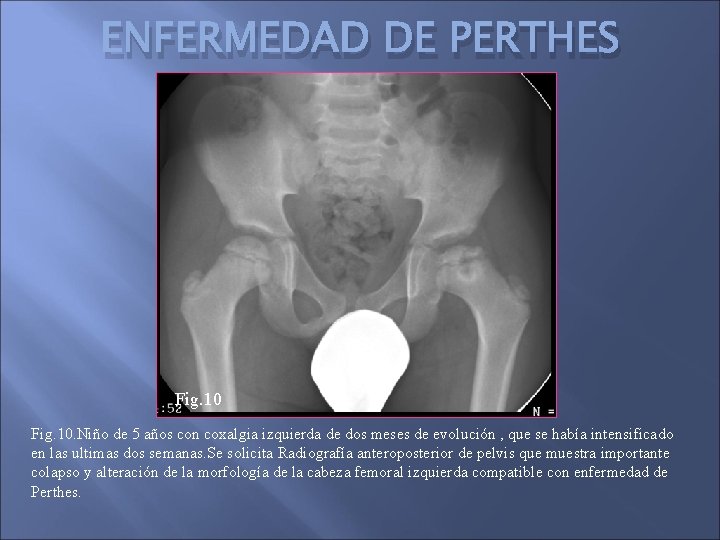 ENFERMEDAD DE PERTHES Fig. 10. Niño de 5 años con coxalgia izquierda de dos