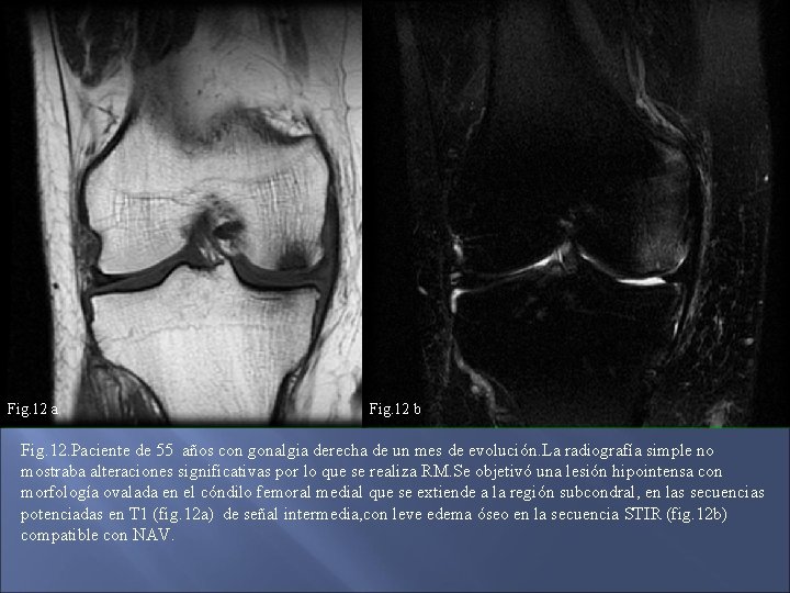 Fig. 12 a Fig. 12 b Fig. 12. Paciente de 55 años con gonalgia