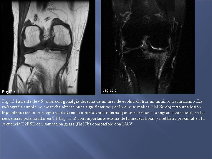 Fig. 13 a Fig. 13 b Fig. 13. Paciente de 45 años con gonalgia