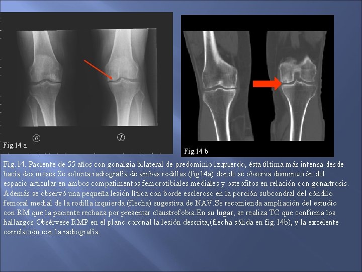 Fig. 14 a Fig. 14 b Fig. 14. Paciente de 55 años con gonalgia