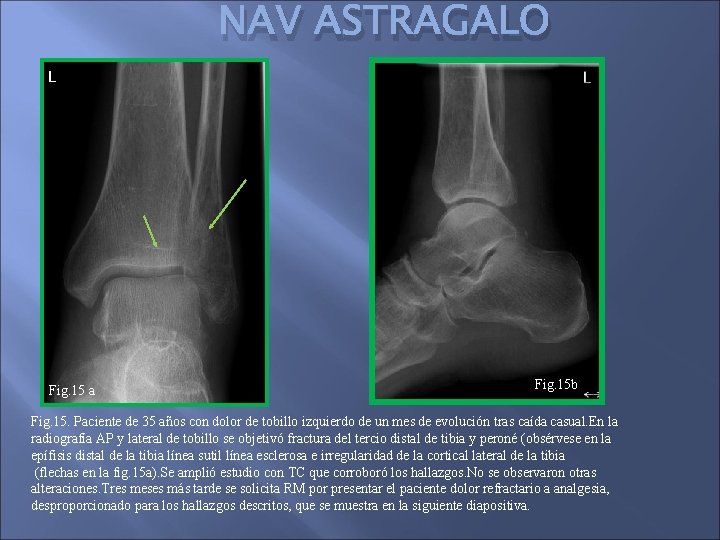 NAV ASTRAGALO Fig. 15 a Fig. 15 b Fig. 15. Paciente de 35 años
